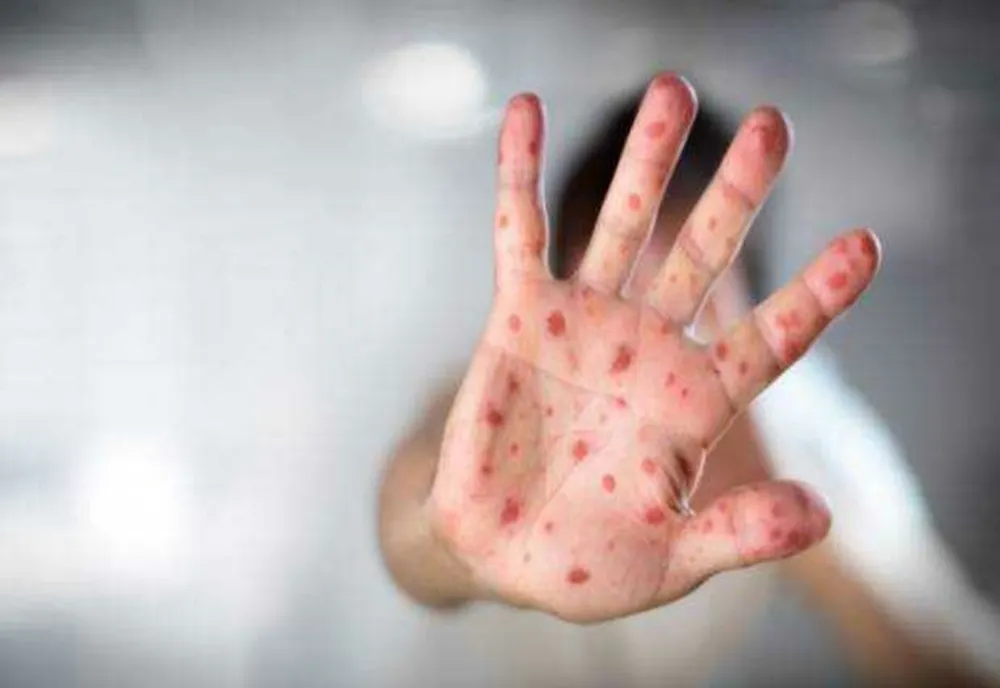 România, pe primul loc în UE la cazurile de rujeolă! Efectul dramatic al prăbușirii ratei de vaccinare în rândul copiilor