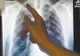OMS: TUBERCULOZA, DIN NOU PE PRIMUL LOC ÎNTRE BOLILE INFECŢIOASE FATALE